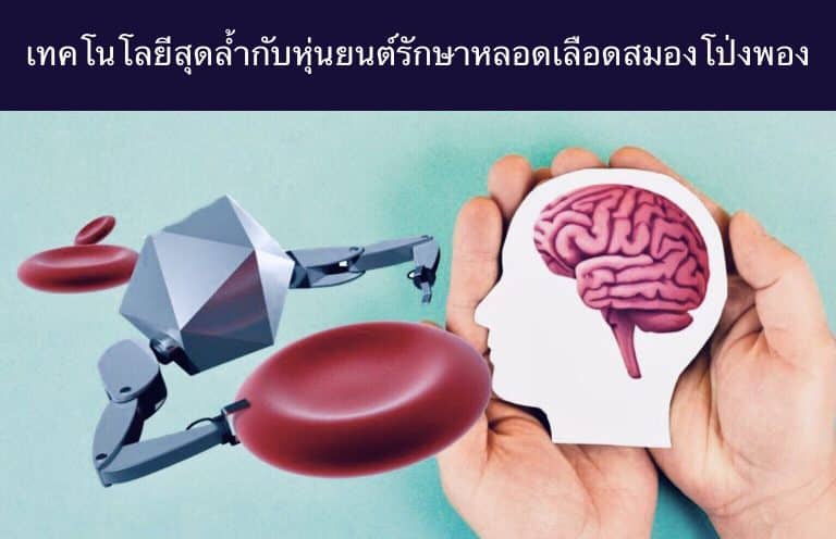 เทคโนโลยีสุดล้ำกับหุ่นยนต์รักษาหลอดเลือดสมองโป่งพอง
