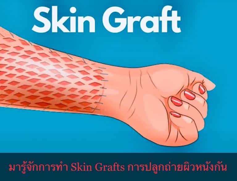 มารู้จักการทำ Skin Grafts การปลูกถ่ายผิวหนังกัน