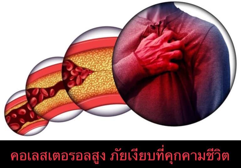 คอเลสเตอรอลสูง ภัยเงียบที่คุกคามชีวิต