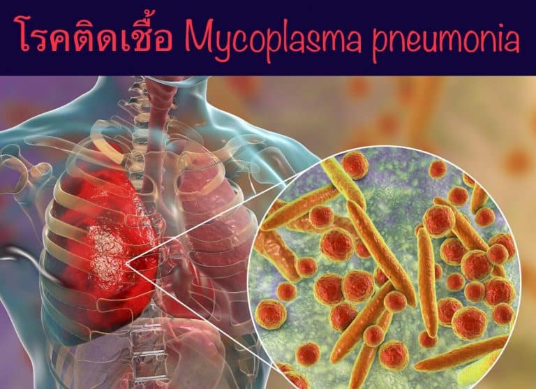 โรคติดเชื้อ Mycoplasma pneumonia
