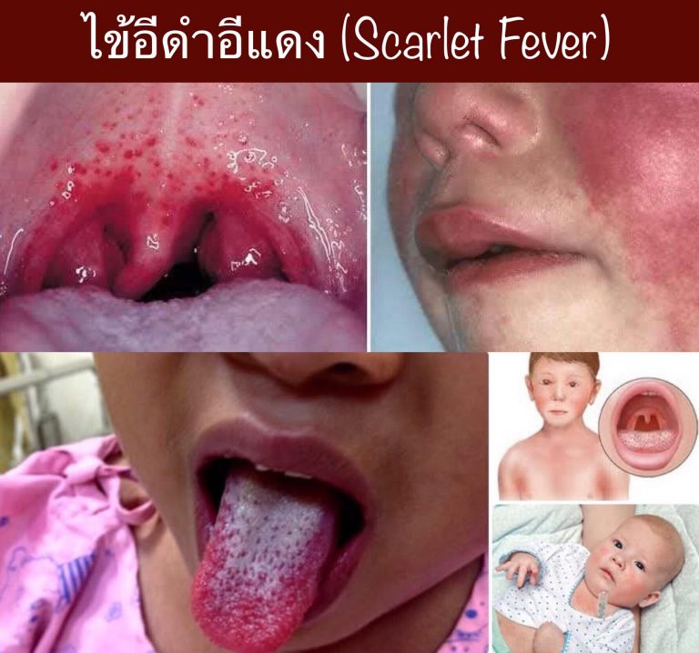 ไข้อีดำอีแดง (Scarlet Fever)