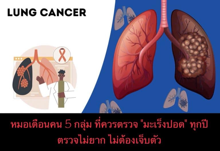 หมอเตือนคน 5 กลุ่ม ที่ควรตรวจ “มะเร็งปอด” ทุกปี ตรวจไม่ยาก ไม่ต้องเจ็บตัว